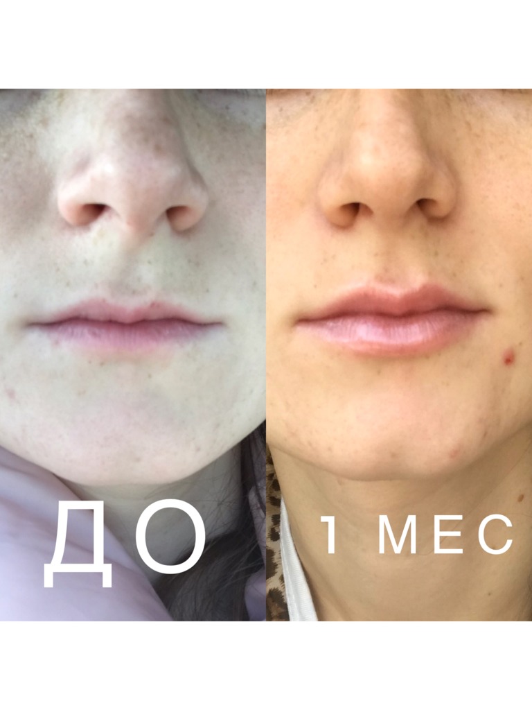 Фото 2. Что нужно делать, если не виден эффект от увеличения губ?