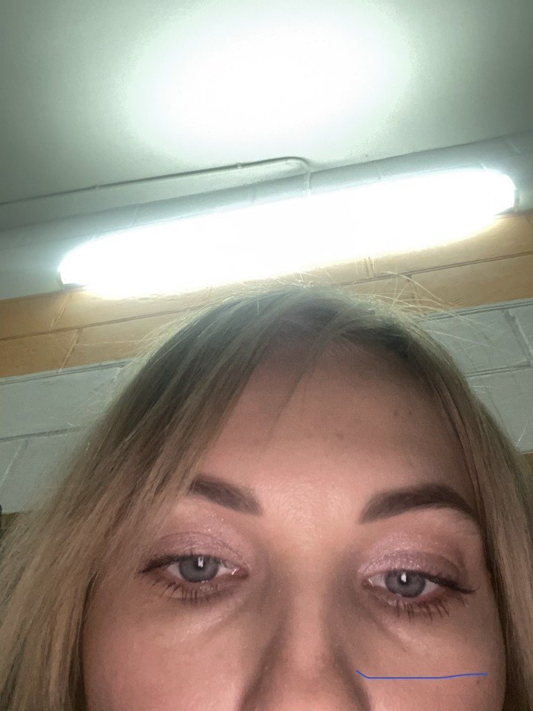 Фото 1. Как убрать Радиесс из носогубки?