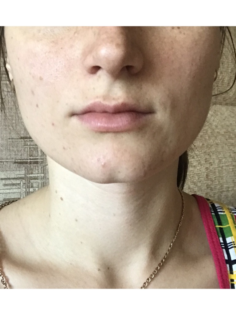 Фото 1. Что нужно делать, если не виден эффект от увеличения губ?