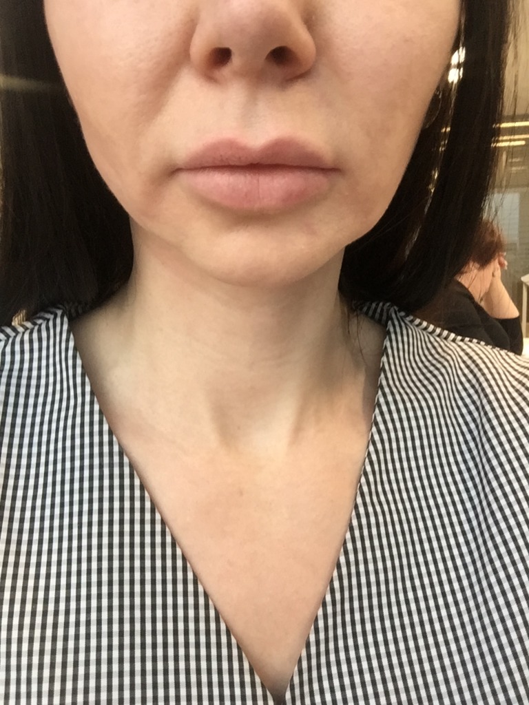 Фото 1. Как вернуть гладкость коже после Радиесс и нитей?