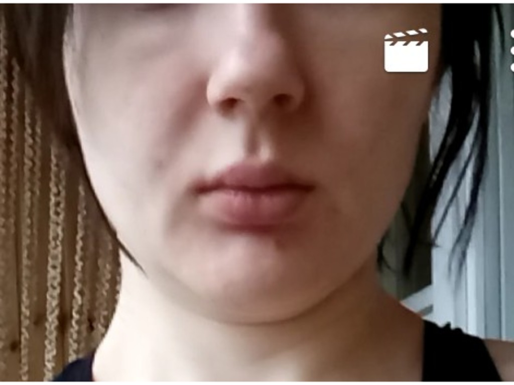 Фото 1. Как можно наполнить объем в зоне щек и поднять уголки губ?