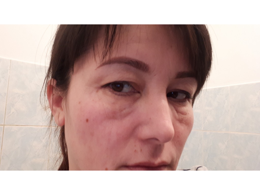 Фото 2. Каким способом можно убрать филлер под глазами? На гиалуронидазу аллергия