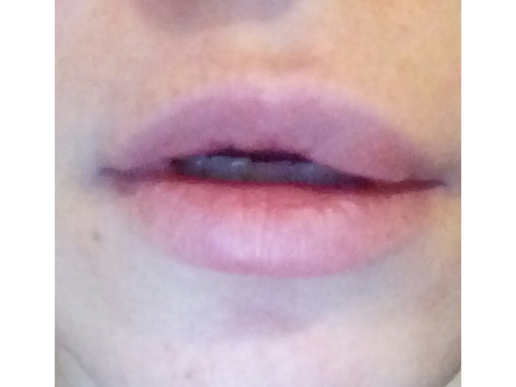 Фото 1. Как избавиться от шариков в губах спустя 4 года после филлера?