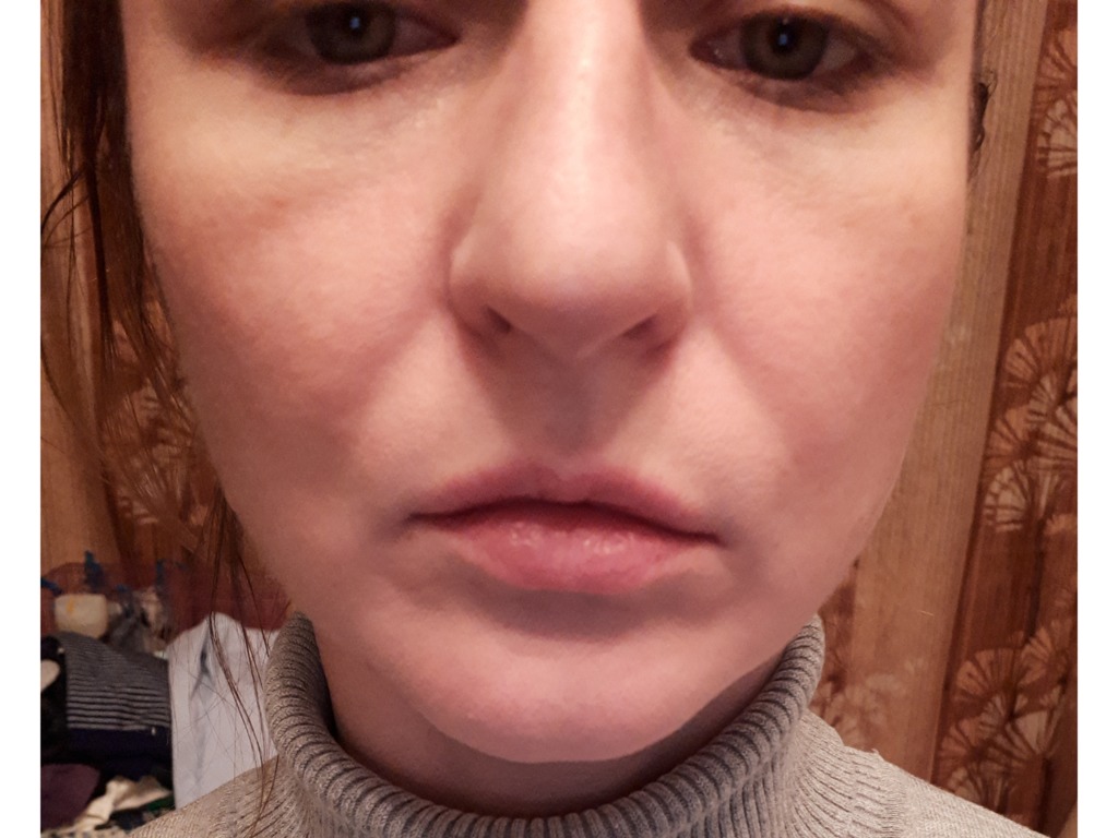 Фото 1. Как лучше убрать носогубки и вмятины под глазами?