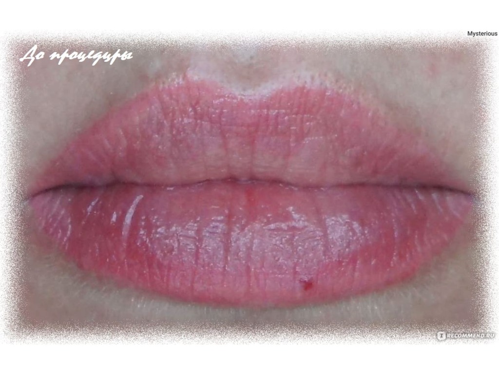 Фото 1. Является ли гемангиома противопоказанием к увеличению губ?