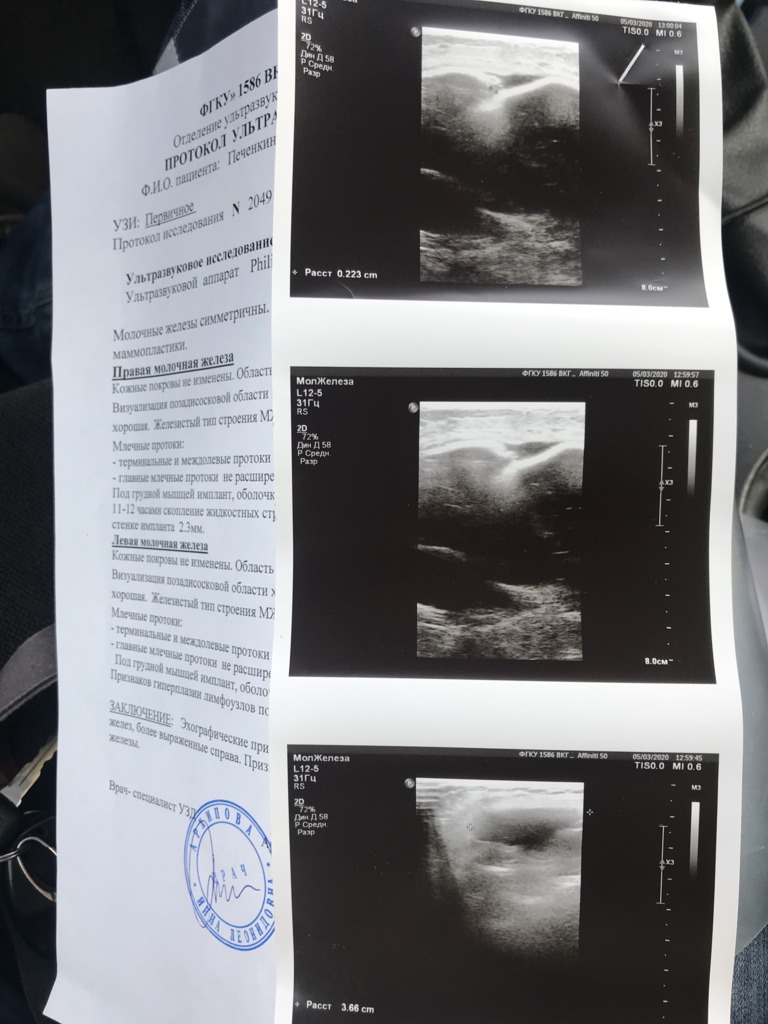 Фото 4. Что делать, если на узи разрыв импланта?
