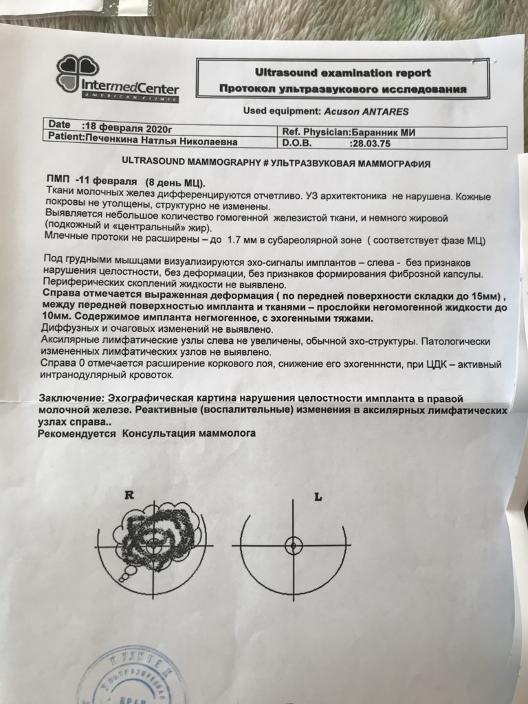 Фото 6. Что делать, если на узи разрыв импланта?