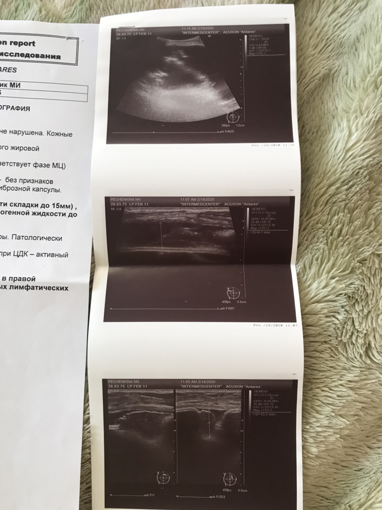 Фото 2. Что делать, если на узи разрыв импланта?