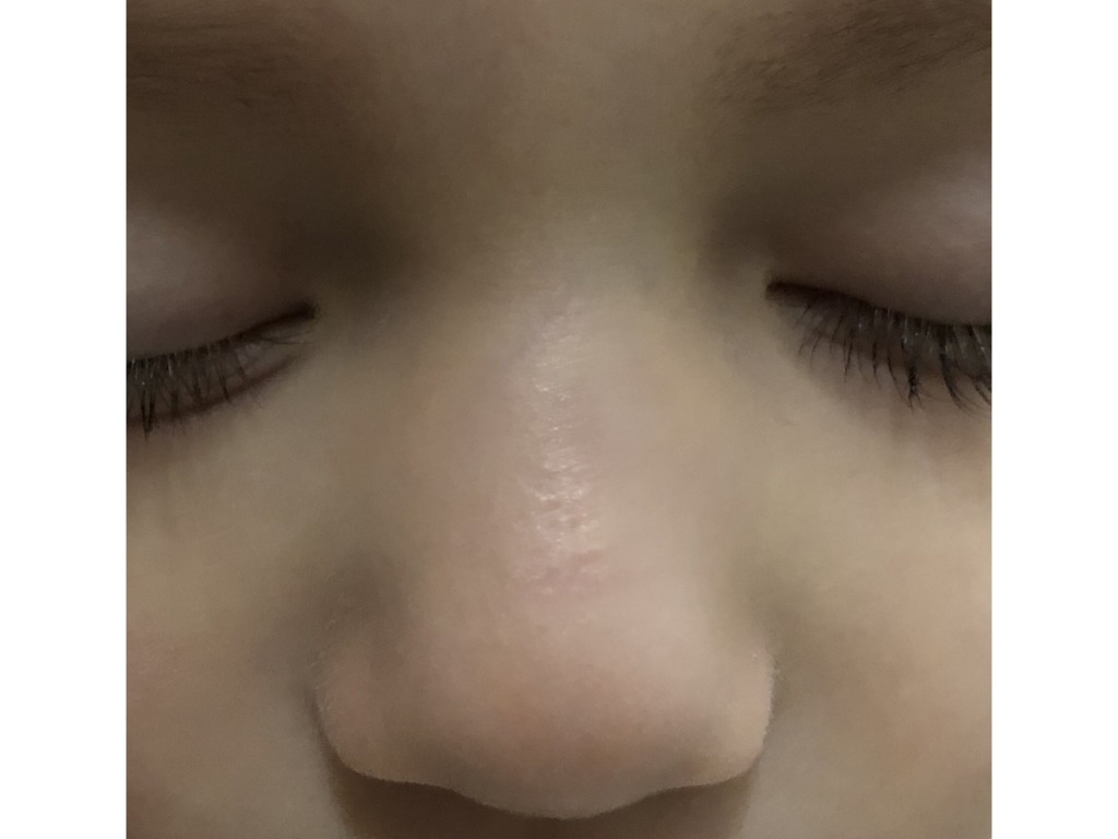 Фото 1. Что можно сделать от шрама ребенку в 2 года?