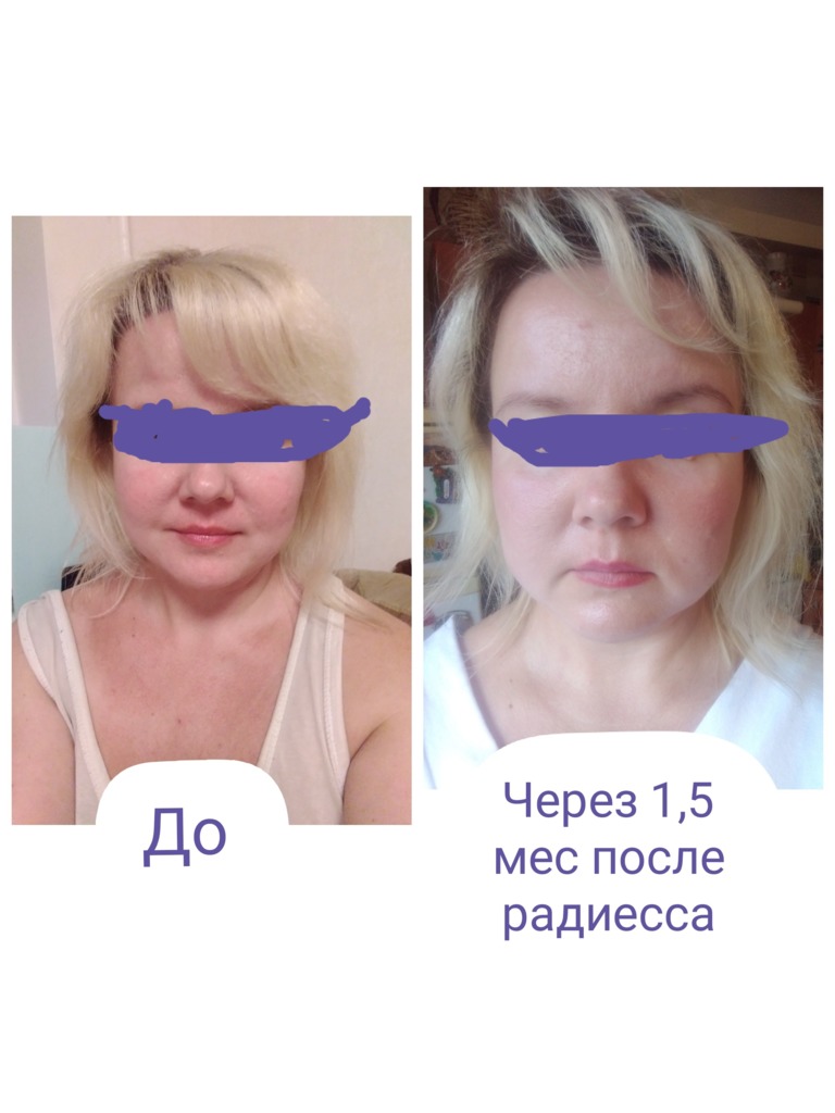 Фото 2. Возможно ли образование фиброза и как убрать отек?