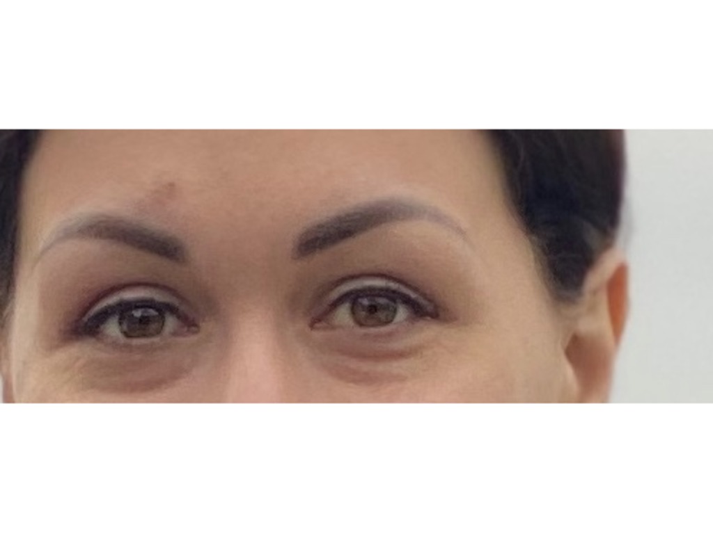 Фото 1. Как убрать отек после удаления филлера? Не проходит 2 месяца.