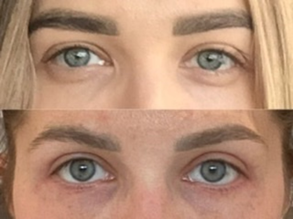 Фото 1. Как можно откорректировать недостатки после блефаропластики?