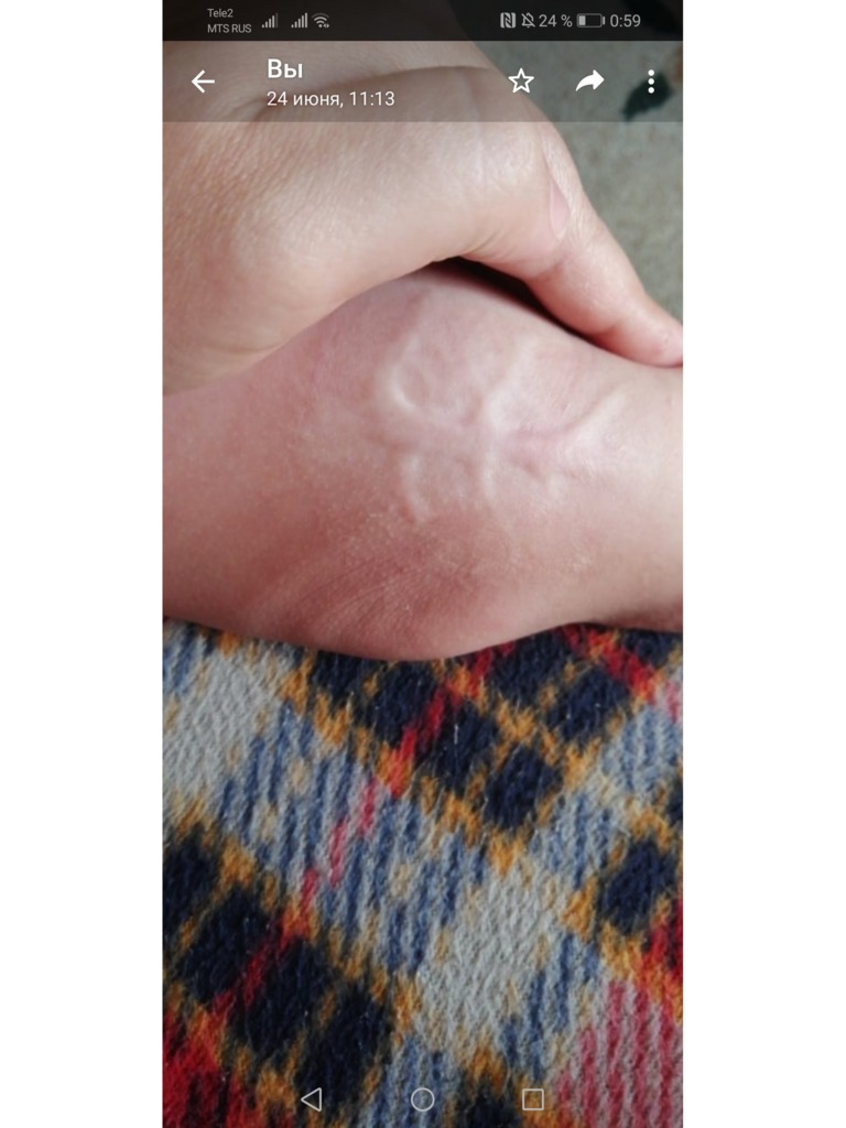 Фото 1. Когда можно иссечь шрам ребенку?