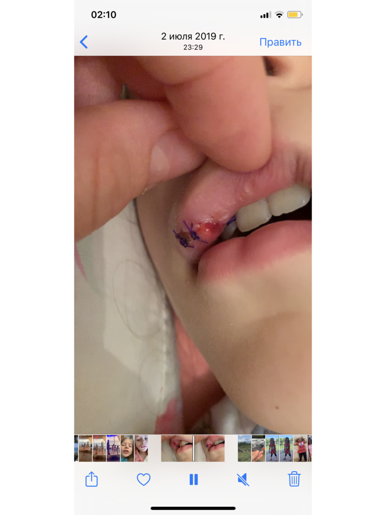 Фото 1. Каким способом можно убрать кусочек лишней ткани на губе у ребенка?