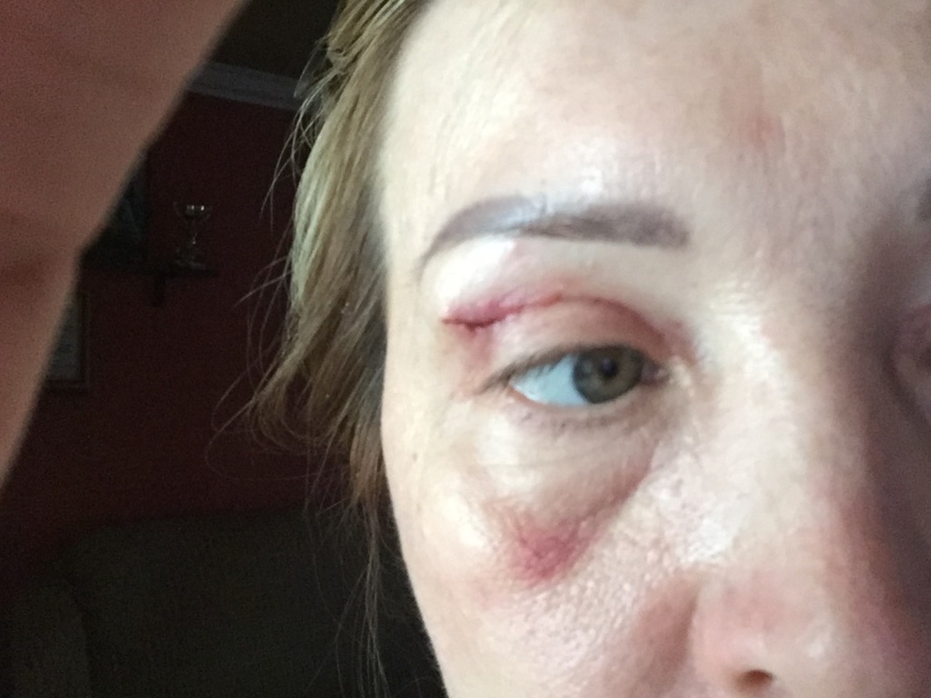 Фото 1. Пройдет ли впадина под глазом после удаления филлера?