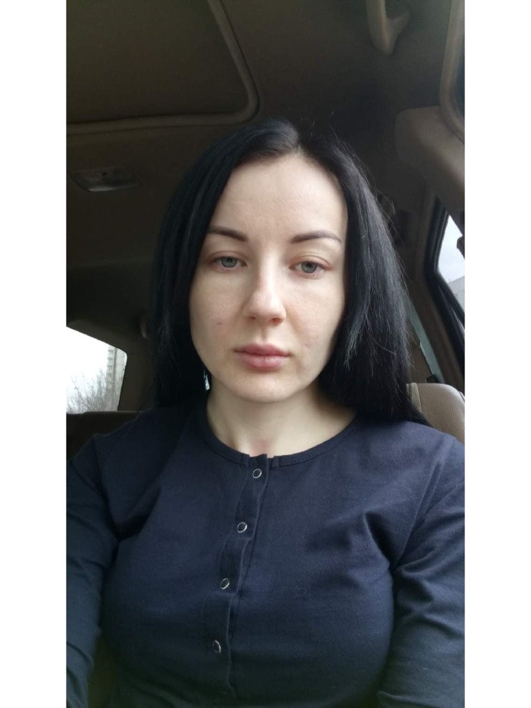 Фото 2. Что мне делать после выведения филлера и как решить проблему носощечных морщин?