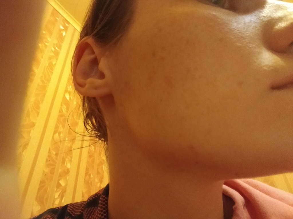 Фото 1. Возможно ли убрать рубец на щеке?