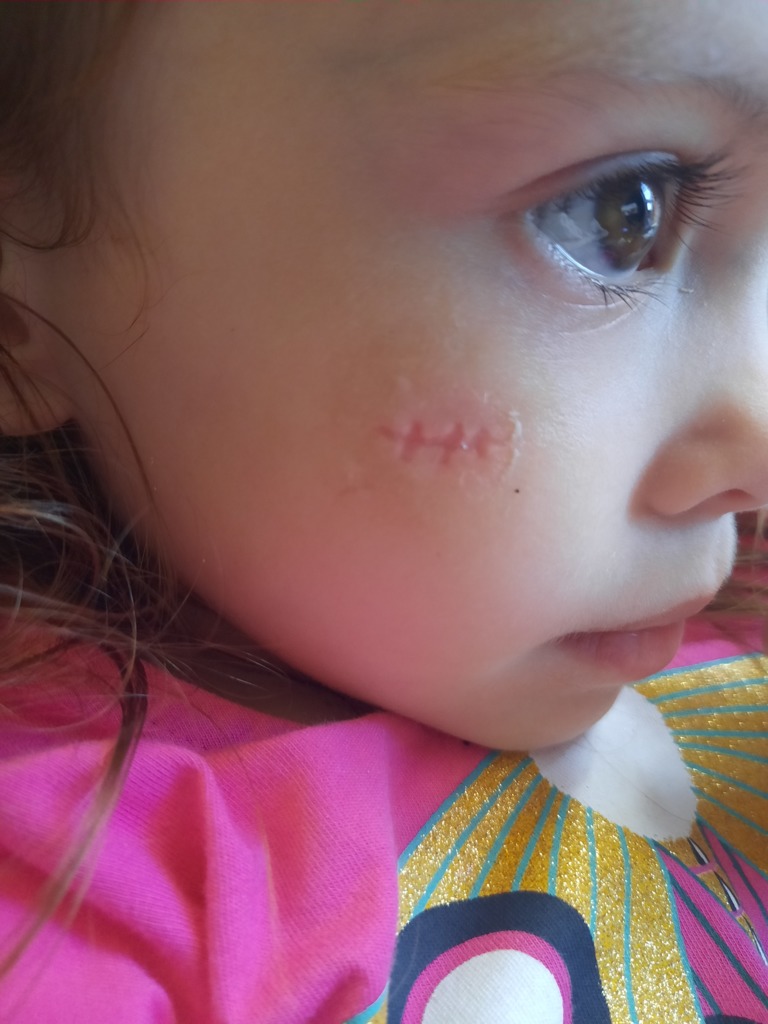 Фото 1. Что нужно делать, чтобы в будущем сгладить шрам на лице?