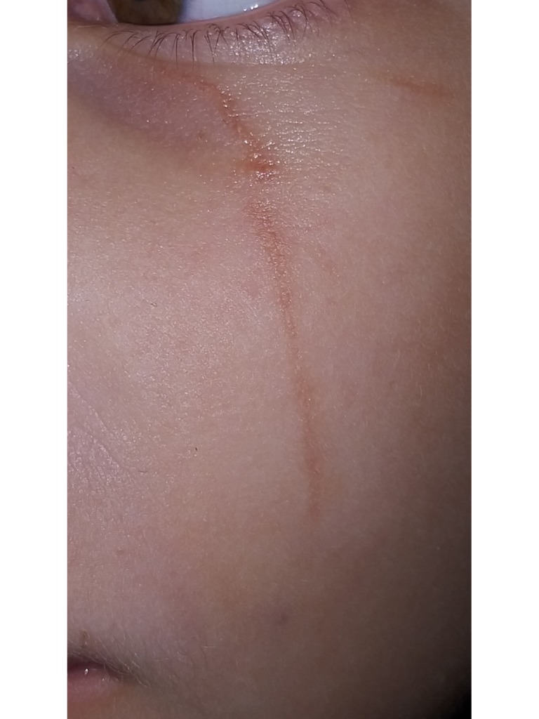 Фото 3. Пройдет ли рубец , образовавшийся после царапин?