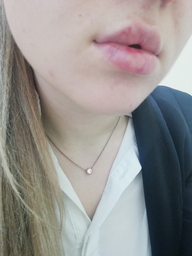 Фото 2. Какова причина белого комка на губе и как его лечить?