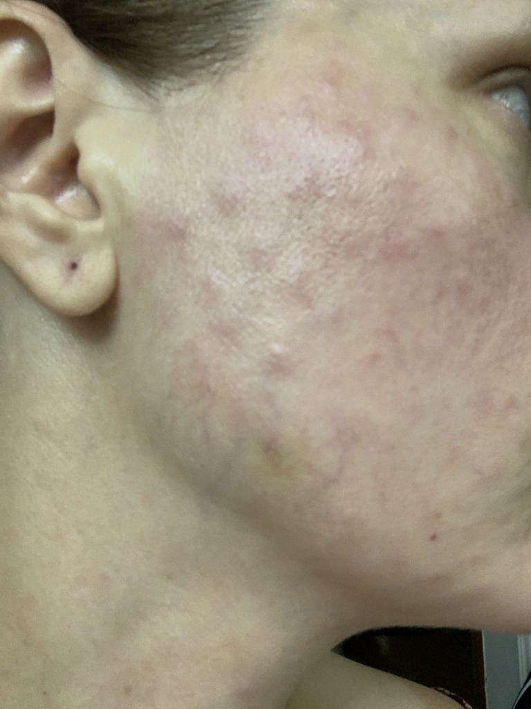 Фото 1. Что же делать, если не проходят папулы уже 1,5 месяца?