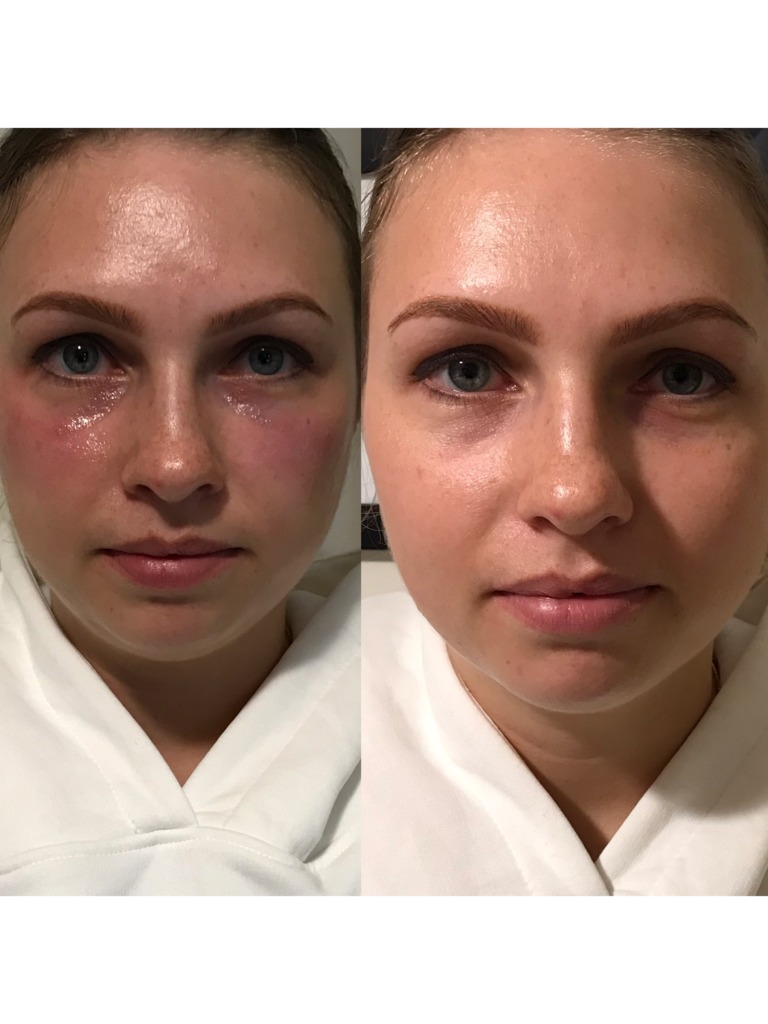 Фото 3. Что делать, если отеки не проходят?