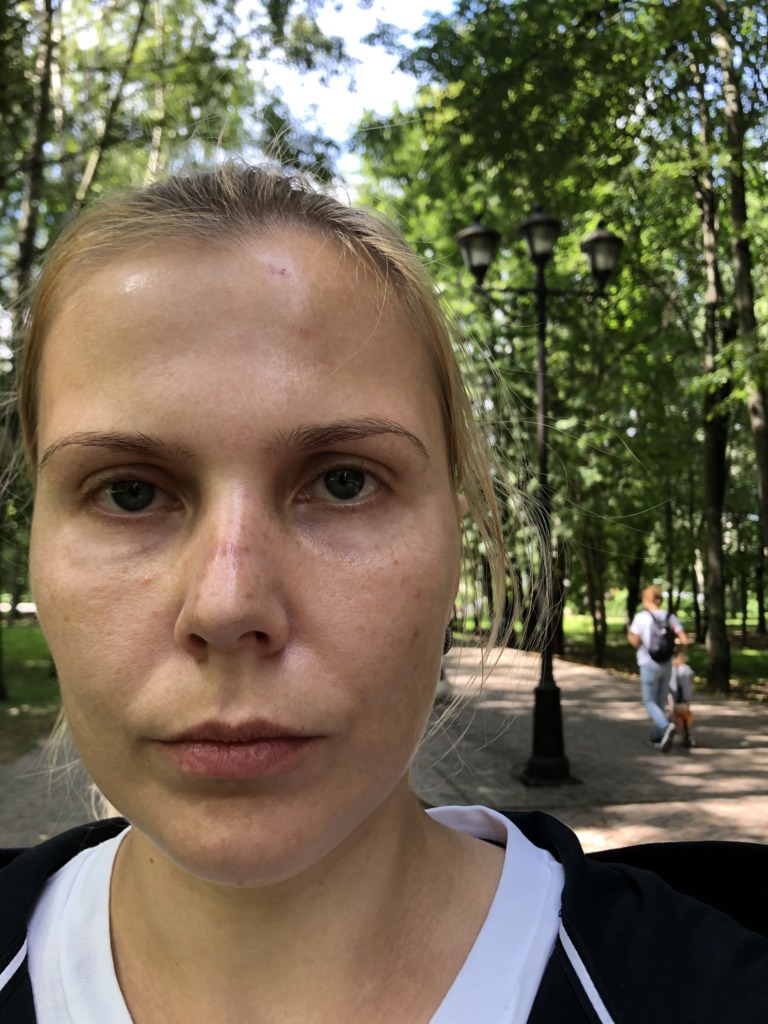 Фото 3. Вернется ли первоначальный вид после выведения филлера гиалуронидазой?