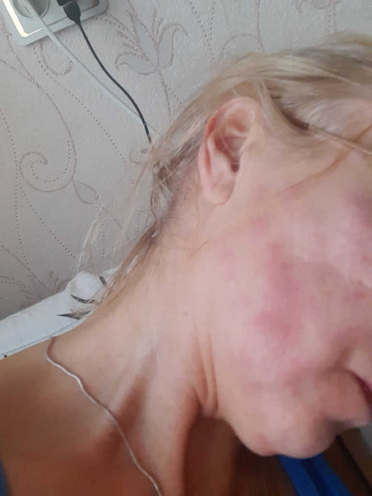 Фото 1. Как улучшить свое сотояние после инъекции Аквашайн?