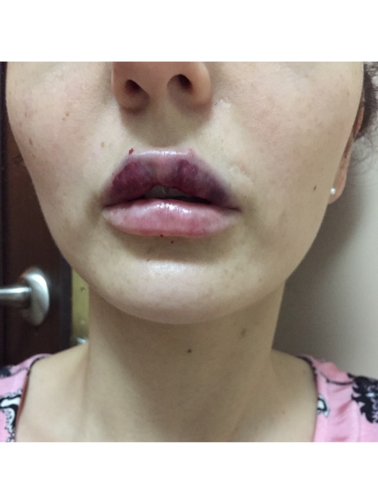 Фото 1. Синяки на губе после филлера это страшно?