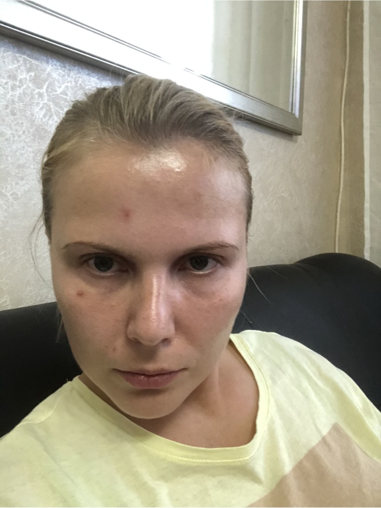 Фото 2. Заменит ли биоревитализация под глазами эффект от филлера?