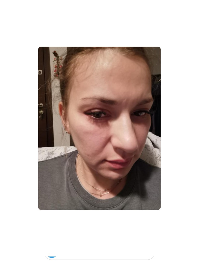 Фото 1. Что делать, отек не проходит?