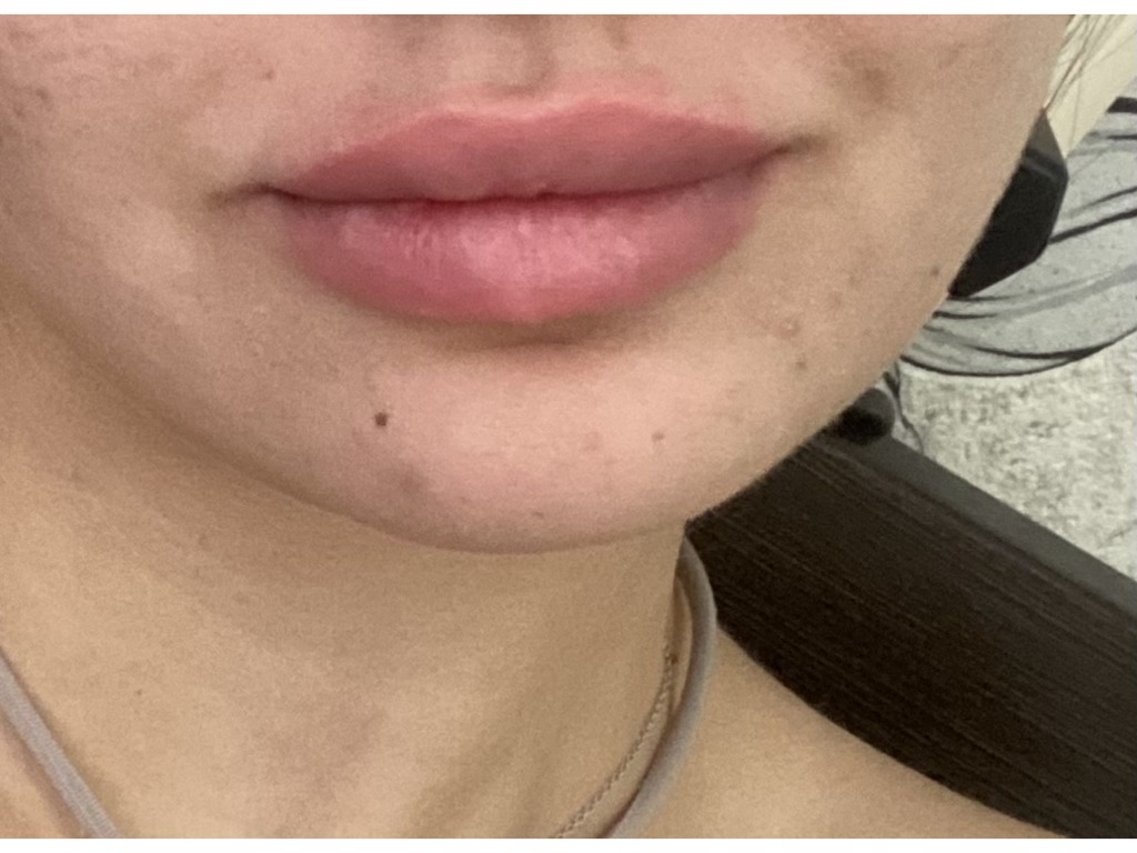 Фото 1. Почему образовывается бугор?