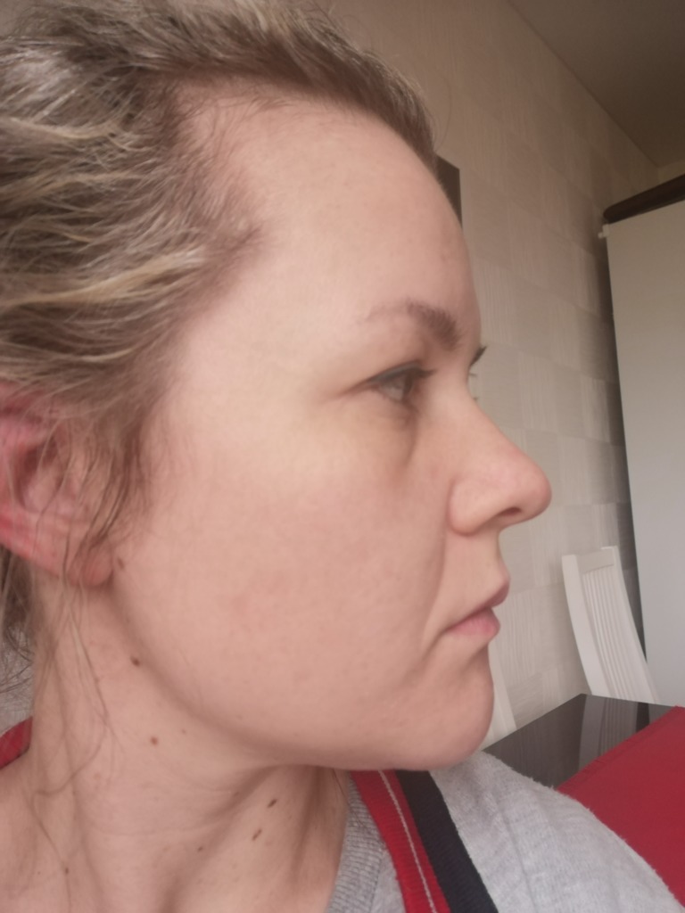 Фото 4. Возможна ли в моем случае трансконьюктивальная пластика?