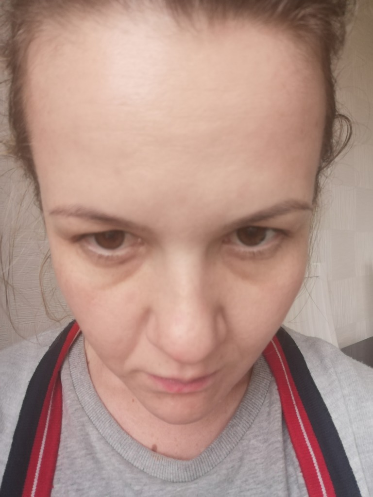 Фото 3. Возможна ли в моем случае трансконьюктивальная пластика?