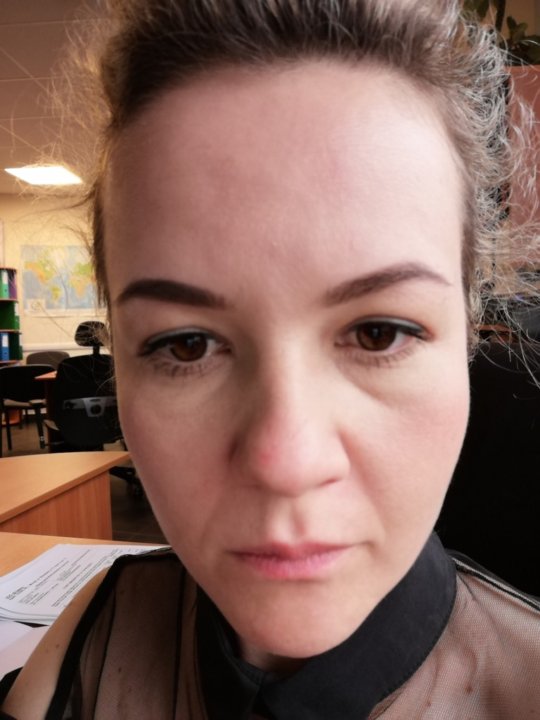 Фото 2. Возможна ли в моем случае трансконьюктивальная пластика?