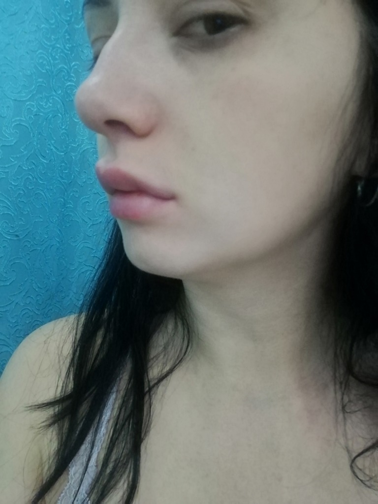 Фото 2. Ждать ли 2 недели после процедуры, чтобы отеки пропали?