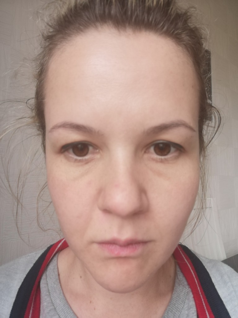 Фото 5. Возможна ли в моем случае трансконьюктивальная пластика?