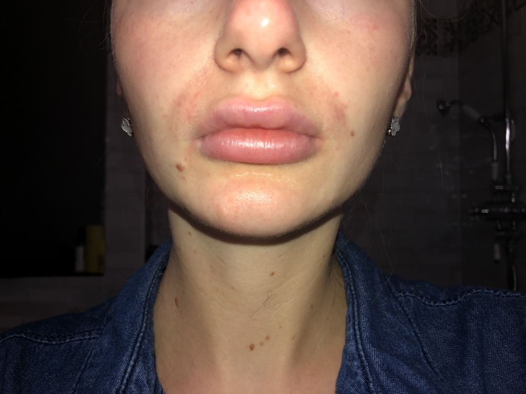 Фото 2. Что делать, если не проходит синева после Radiess?