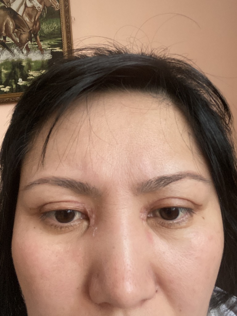 Фото 1. Как исправить образовавшийся рубец на эпикантусе?