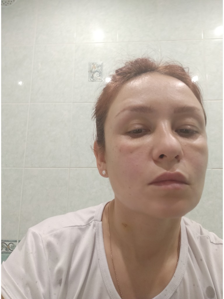 Фото 1. Как избавиться от отеков?