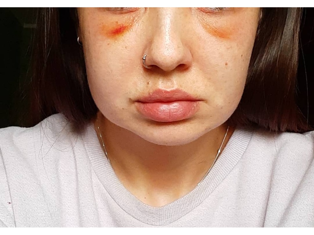 Фото 1. Ждать еще или выводить филлер?