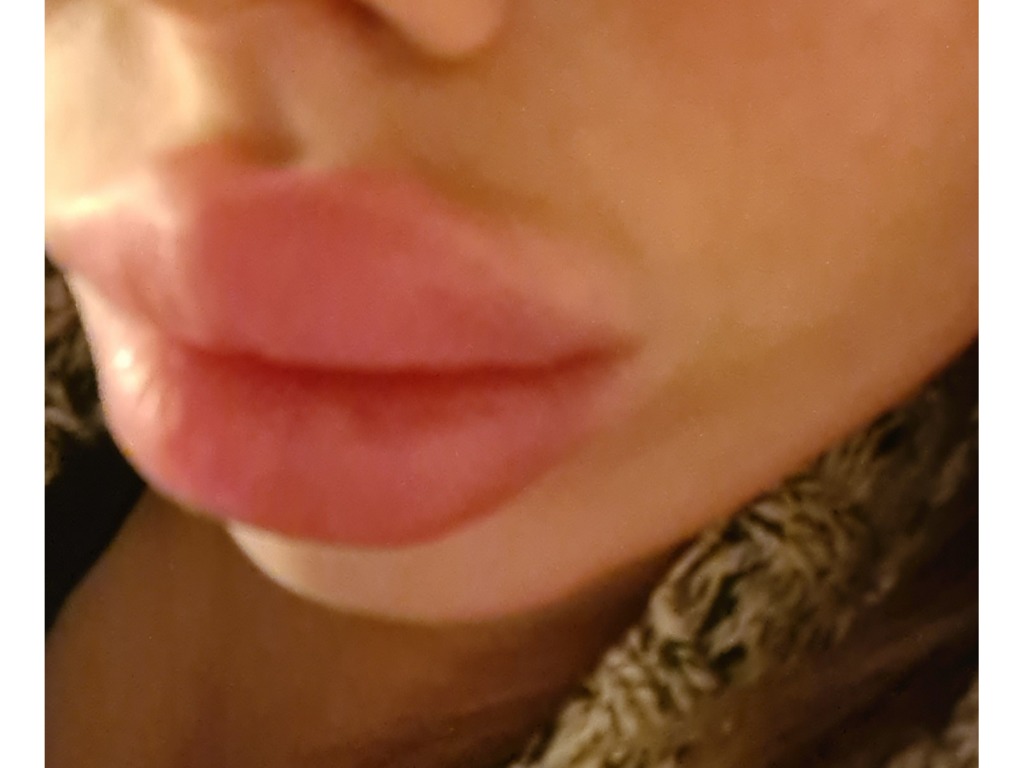 Фото 2. Как часто можно рассасывать гиалуроновую кислоту в губах?