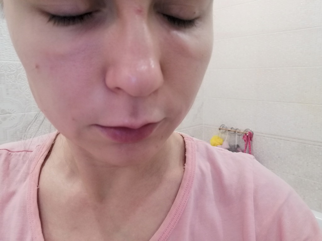 Фото 1. Сильно болит носослезка, должно ли так быть?