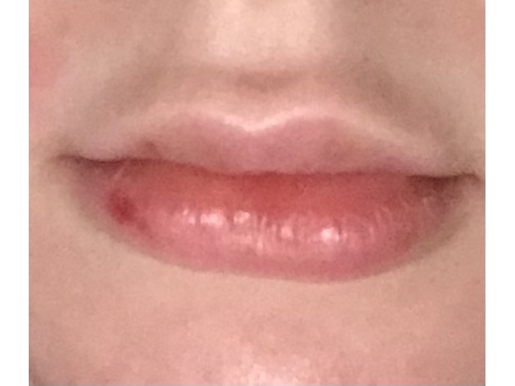 Фото 1. Можно ли массажем передвинуть гель, чтобы убрать ассиметрию?