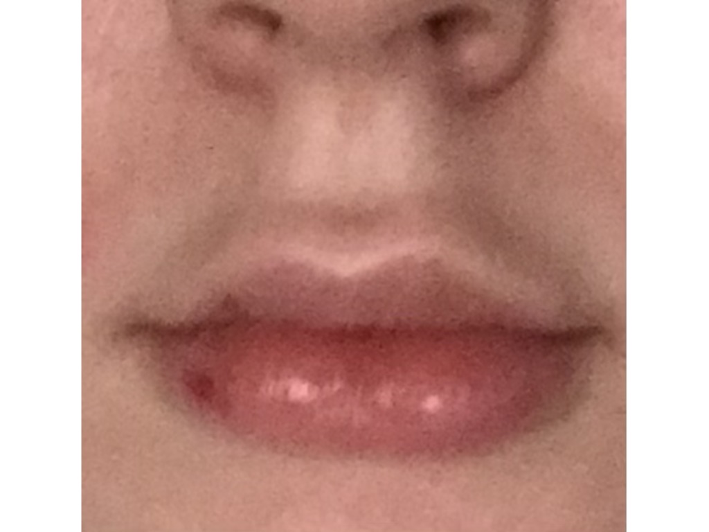 Фото 2. Можно ли массажем передвинуть гель, чтобы убрать ассиметрию?