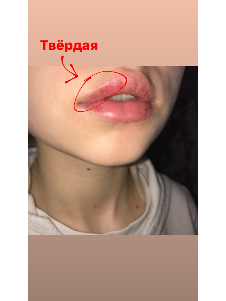 Фото 2. Нужно ли разминать комочки в губе?
