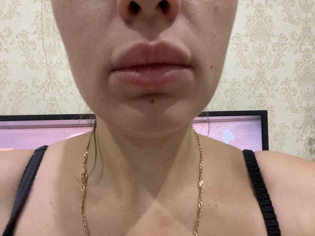 Фото 1. Как исправить заломы, образовавшиеся спустя 2 года после коррекции?