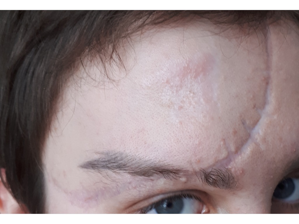 Фото 1. Как сгладить шрам?