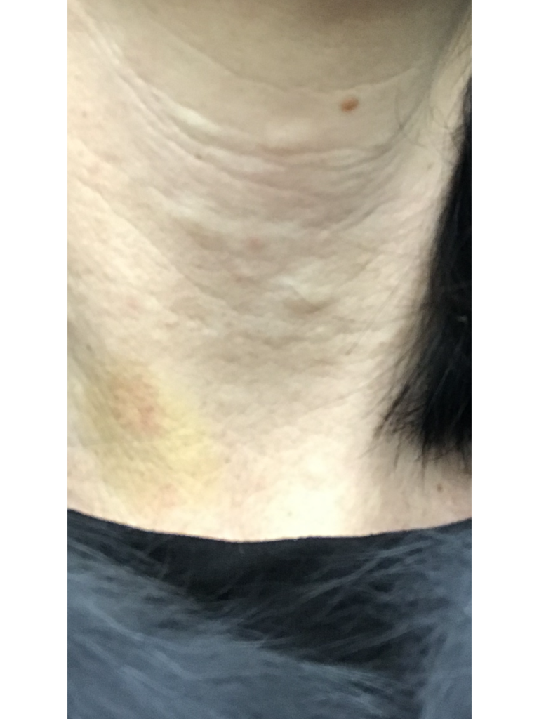 Фото 1. Пройдут ли шишки от армирования филлером?