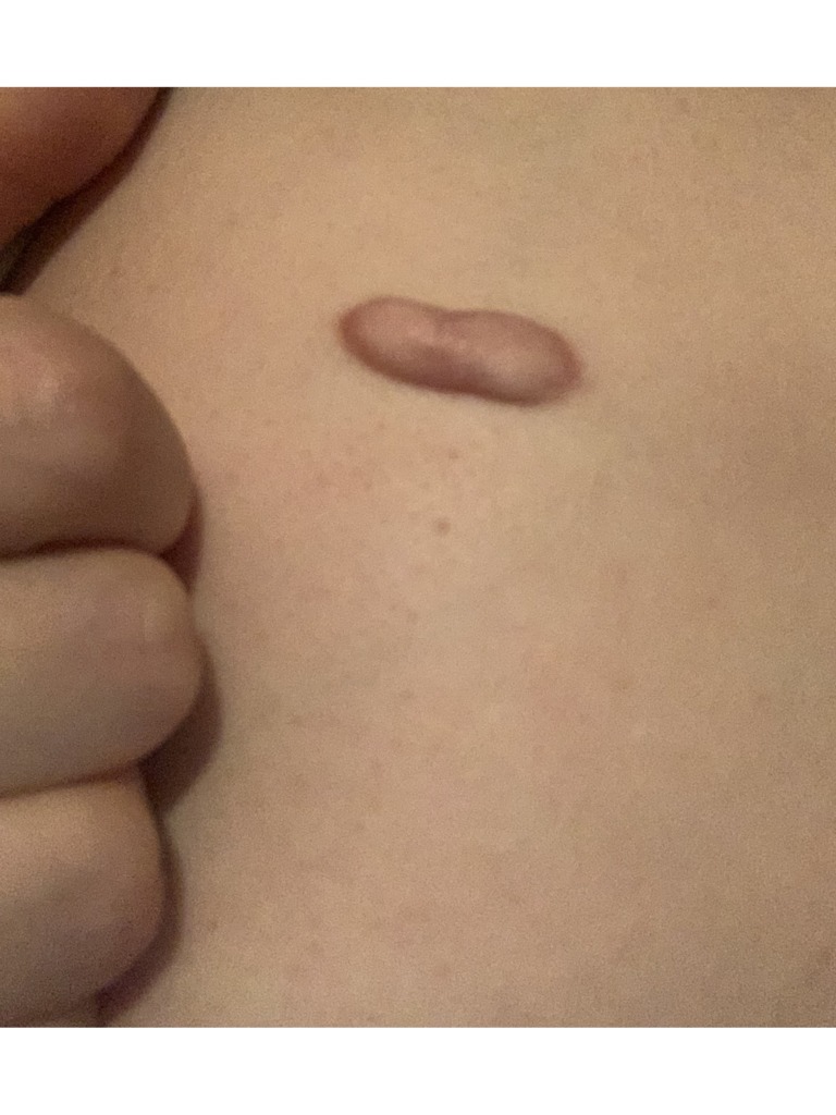 Фото 1. Если есть келоид, можно ли увеличивать губы? Это безопасно?